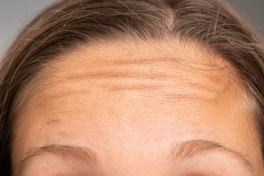 A closeup view on the forehead and hairline of a young Caucasian woman with light brown hair and tanned skin. Wrinkles are seen in the forehead.